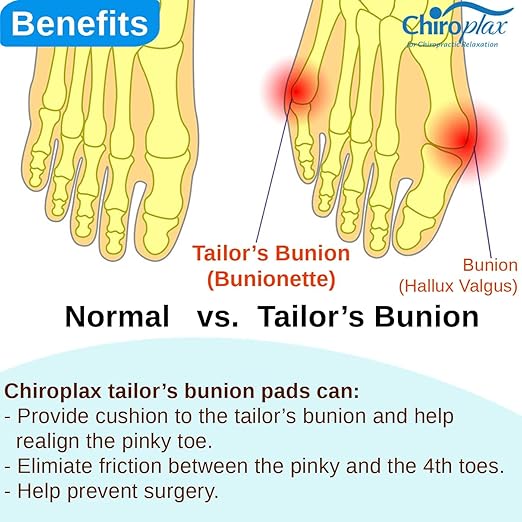 Chiroplax Tailor's Bunion Corrector Pad Bunionette Straightener Separator Cushion Pinky Toe Protector Shield Pain Relief Spacer Splint Cover Guard (Small, 6 Pack)