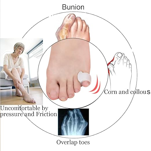 10 Pcs Pinky Toe Splint, Gel Toe Separators, Little Toe Straightener Hammer Toe for Men Women Walking, Running, Overlapping, Bunion Corrector and Bunion Relief