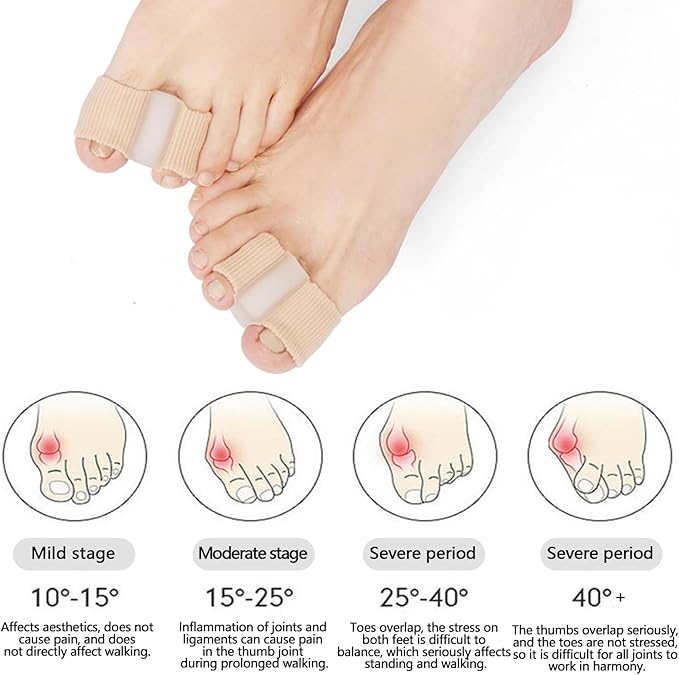 Toe Separators for Overlapping Toes, Hammer Toe Straightener, Toe Spacers Women Men, Gel Toe Separators to Correct Your Toes,Toe Separator for Bunion Pain Relief for Hallux Valgus, Foot Pain (L)