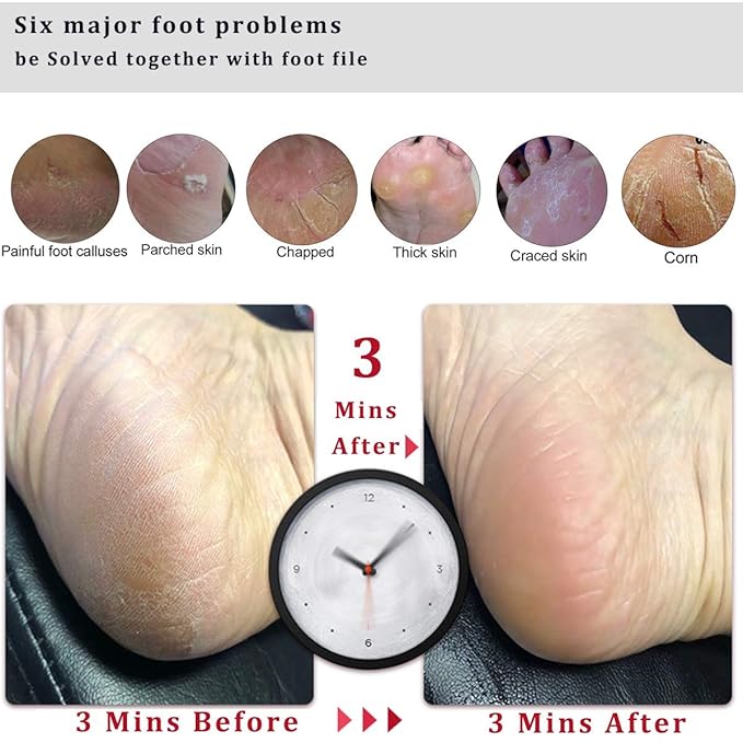 Foot Scrubber Pedicure Foot File Pumice Stone,Professional Pedicure Supplies Callus Remove Cracked Heels,Dead Skin,Corn,Scraper File Foot Care Foot Rasp Massage Brush Tools Kit for Men/Women