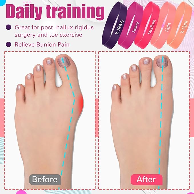 Set of 5 Toe Stretcher Bands for Bunions Correction Foot Big Toe Spacers Resistance Straightener Loop Bands with Carry Bag for Women Men Hallux Valgus Alignment Yoga Exercise(Pink)