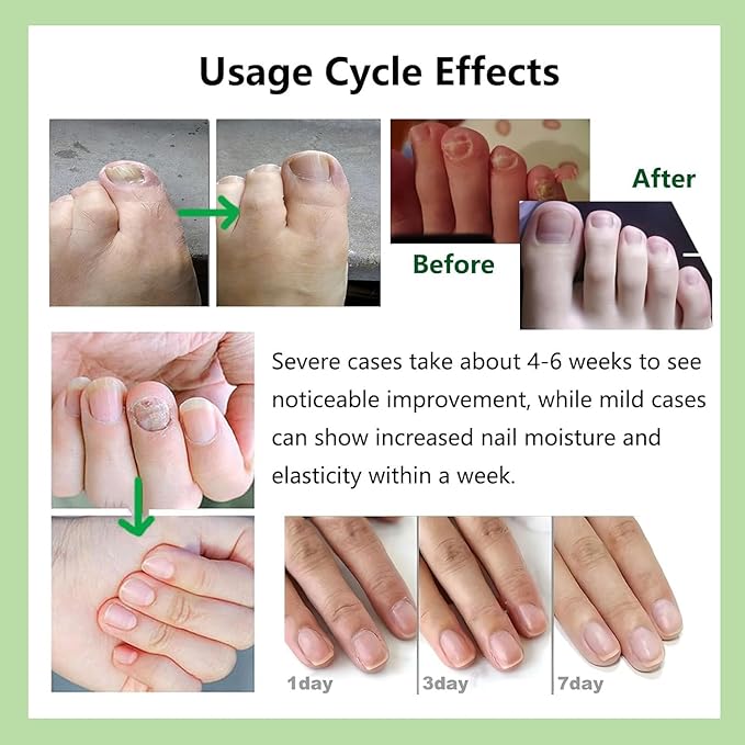 Natural Nail Care Gel, Nutraboost Strengthening Cuticle Serum for Damaged & Brittle Nails, 20ml (1 pcs) (1pcs)