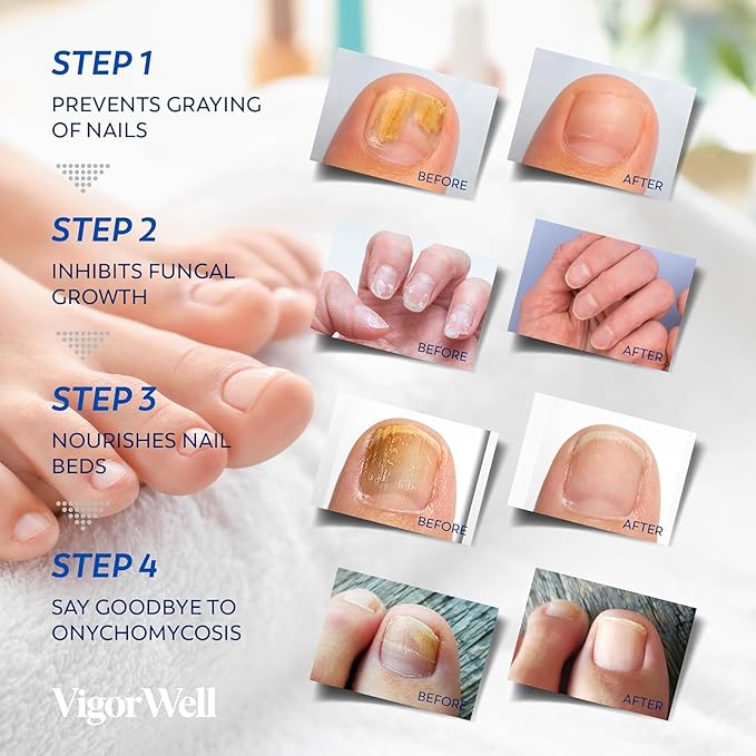 Toenail Fungus Treatment Extra Strength: (Medium) 64 Nighttime Hydrogel Patches for Overnight Repair - Visible Results in 8 Hours - Fungal Nail Patches for Toenail Fungus