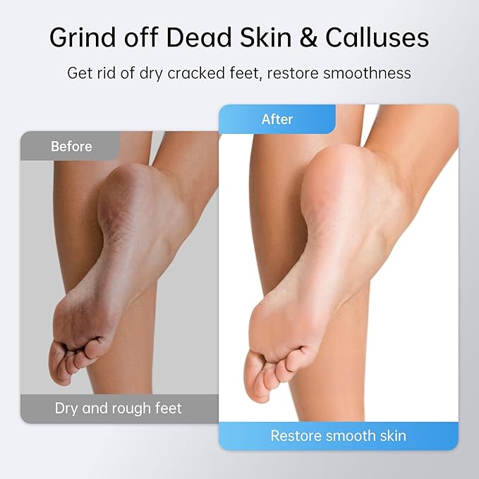 Electric Foot Callus Remover Rechargeable, 6 Speeds, Charging Base, Portable Electric Foot File Pedicure Tools for Dead Skin & Cracked Heel