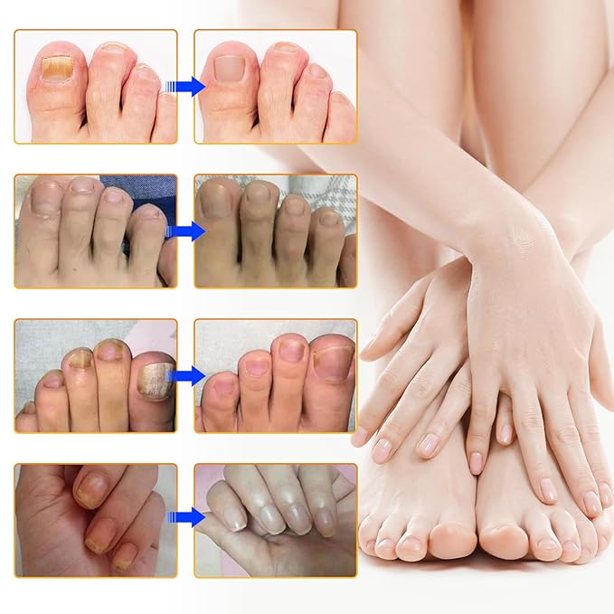 3Pack Toenail Treatment Extra Strength - 96 Pcs Nail Patches, 8-Hrs Overnight Nail Repair, Safe for Sensitive Skin, Easy to Apply