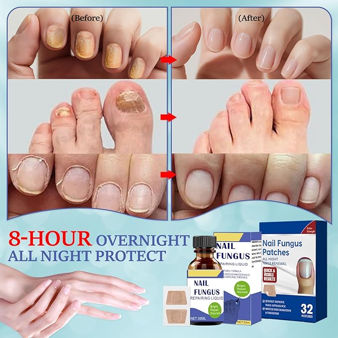 Toenail Fungus Treatment Extra Strength Kit, 30ml Nail Repair Solution and 32 Nail Renewal Patches for Damaged Thick Discolored Toenails and Fingernail