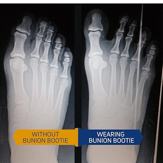 Bunion Corrector for Women Big Toe & Men – Ultra-Thin Toe Separator Sock for Pain Relief of Bunions – Flexible Hallux Valgus Splint That Easily Fits in Shoes – Great Toes Straightener. Med-Left