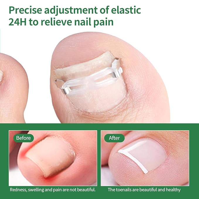 Ingrown Toenail Treatment, 10 packs Ingrown Toenail Corrector, Ingrown Toenail Removal Kit for Curved Nail Repair, Corrector for Man and Women All Size Toenail
