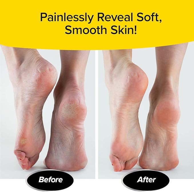 PedEgg Classic Callus Remover, As Seen On TV, New Look, Safely & Painlessly Remove Tough Calluses Dry Skin to Reveal Smooth Soft Feet, 135 Precision Micro-Blades, Traps Shavings