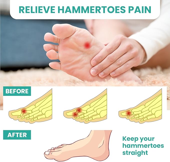 Welnove Hammer Toe Straightener Toe Corrector for Women - 8 Pcs Hammer Toe Cushion Pads for Bent, Crooked, Curled, Claw, and Hammer Toes - Soft Support and Realignment(Clear, 3 Loop Design)