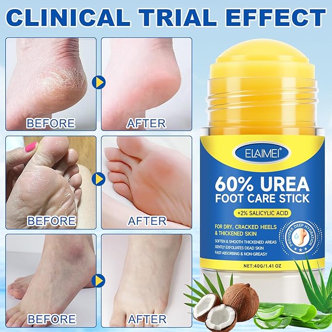 60% Urea with 2% Salicylic Acid Urea Foot Care Stick, Foot Cream Stick for Dry Cracked Heels, Feet Callus Remover, Hands Knees Exfoliating Dead Skin,Callus Remover & Skin Softener -1.41oz